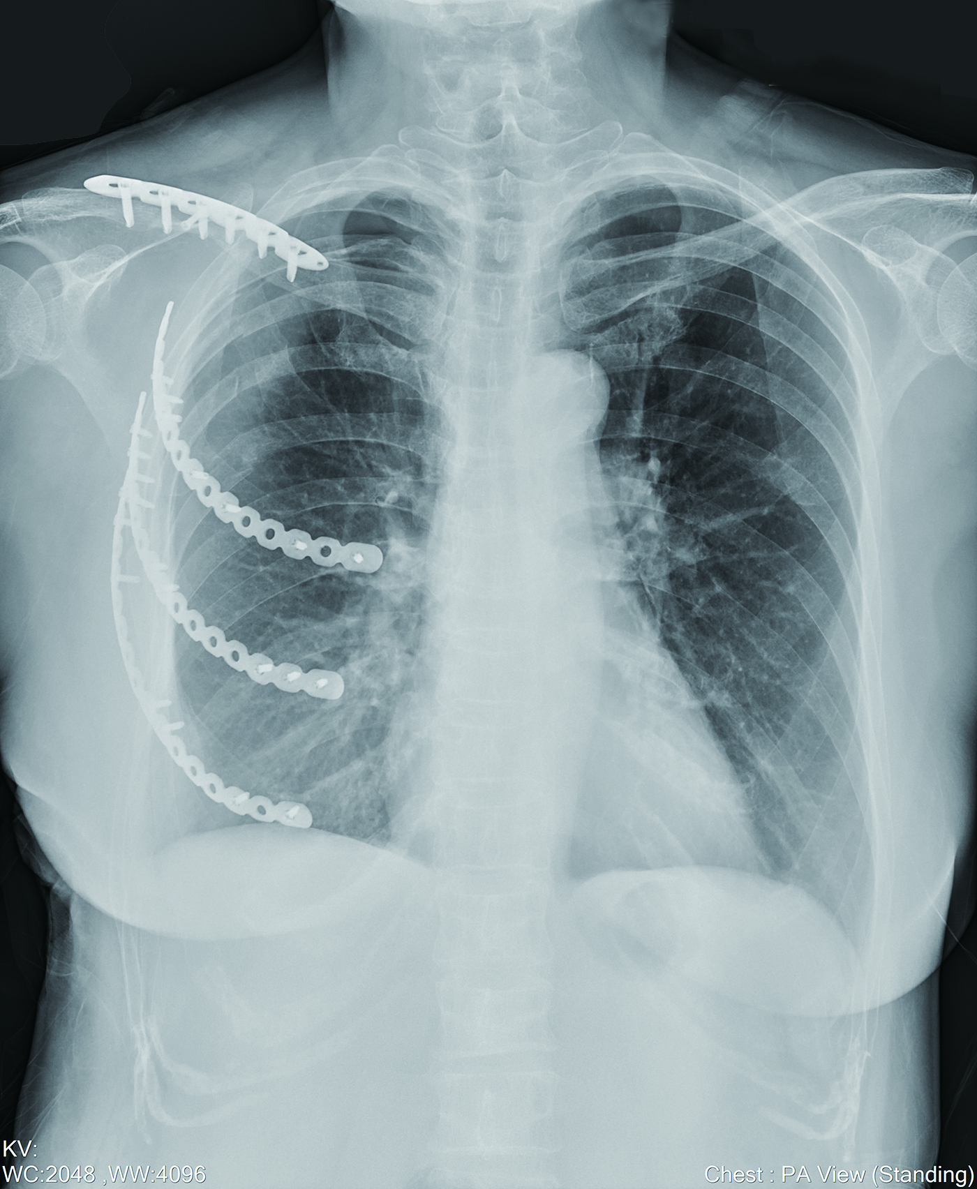 肋骨CT重建：CPR、MPR！_医学界-助力医生临床决策和职业成长