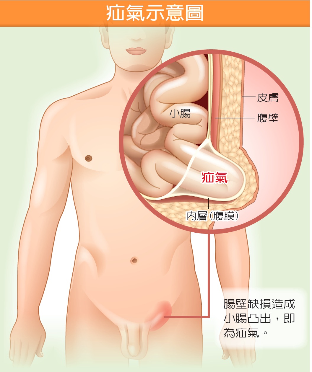 hernias