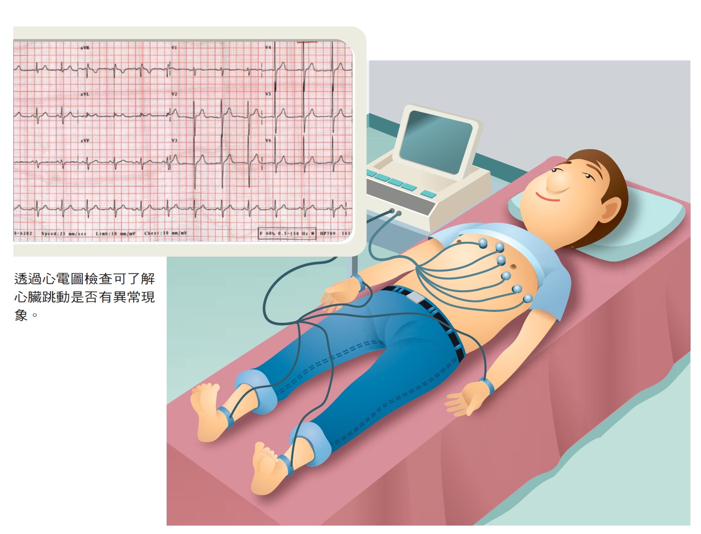 ECG-s