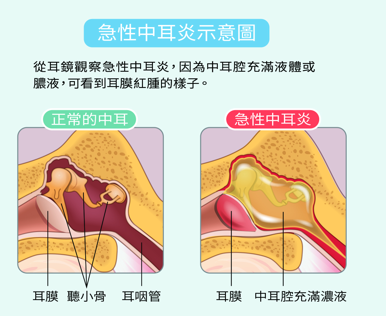 中耳炎反覆發作與慢性中耳炎的處理