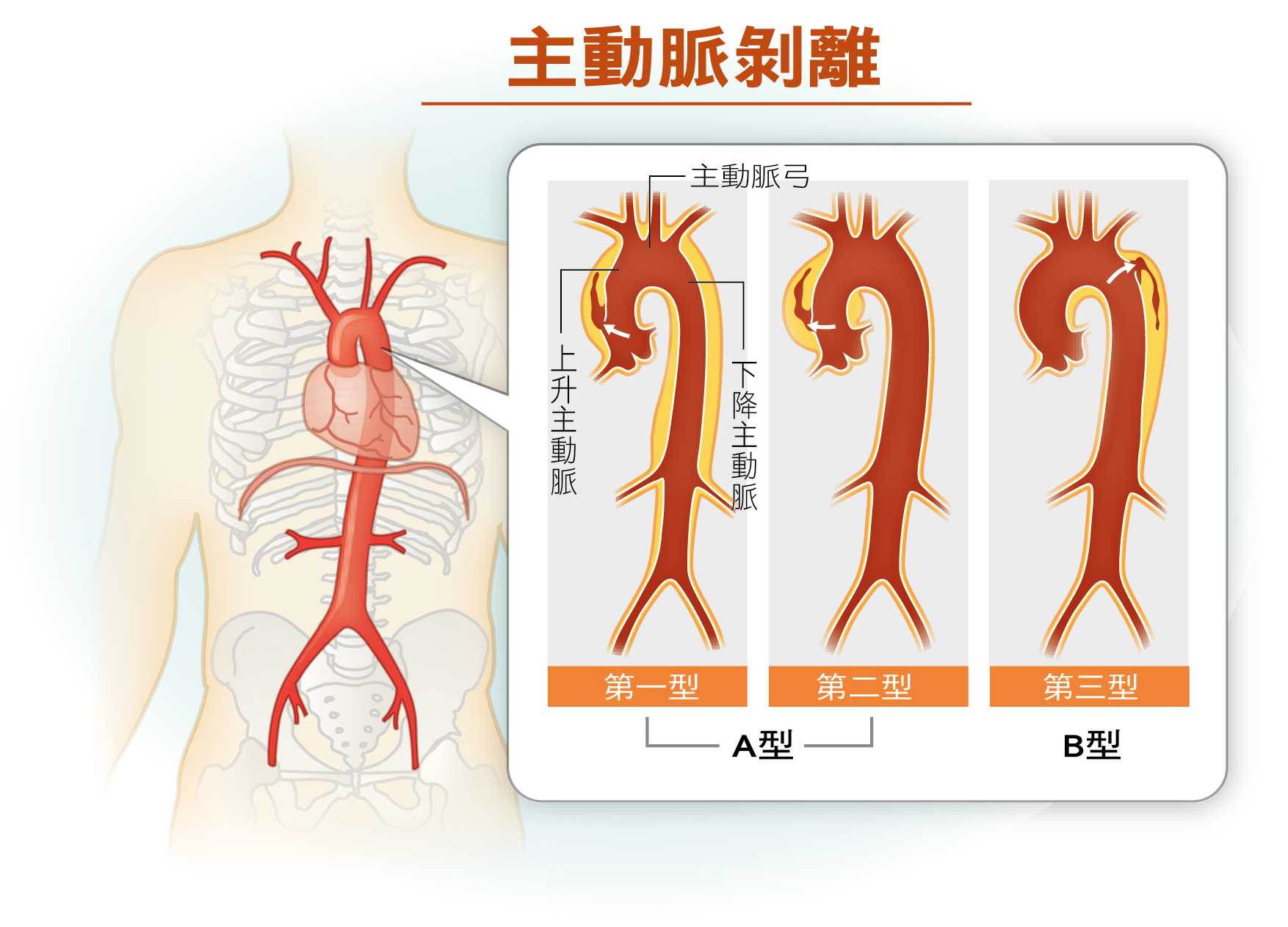 血管壁裂、血液竄流…主動脈剝離的致命危機 - 第38期 - 健康刊物 | 全民健康基金會
