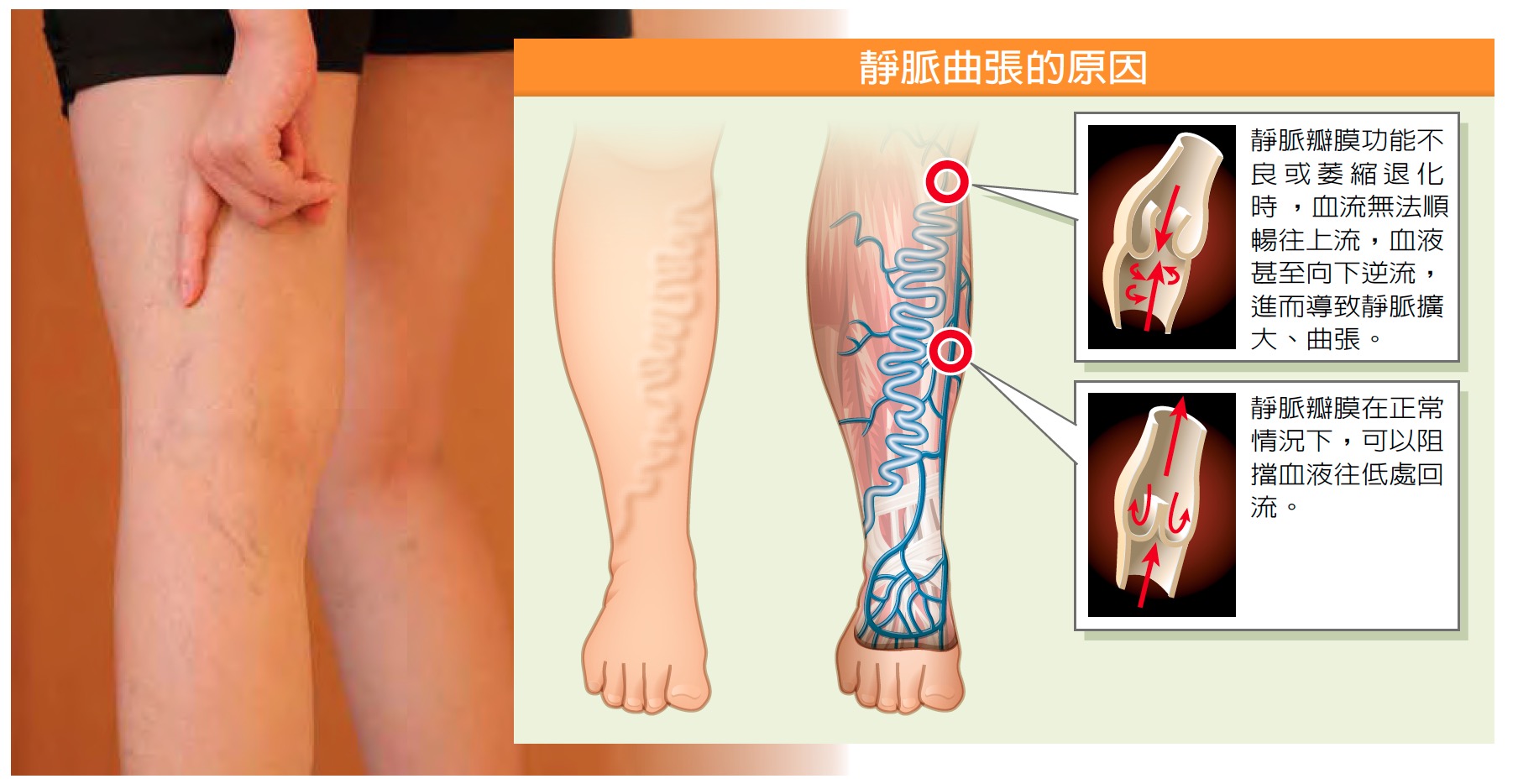 腳 浮 青筋