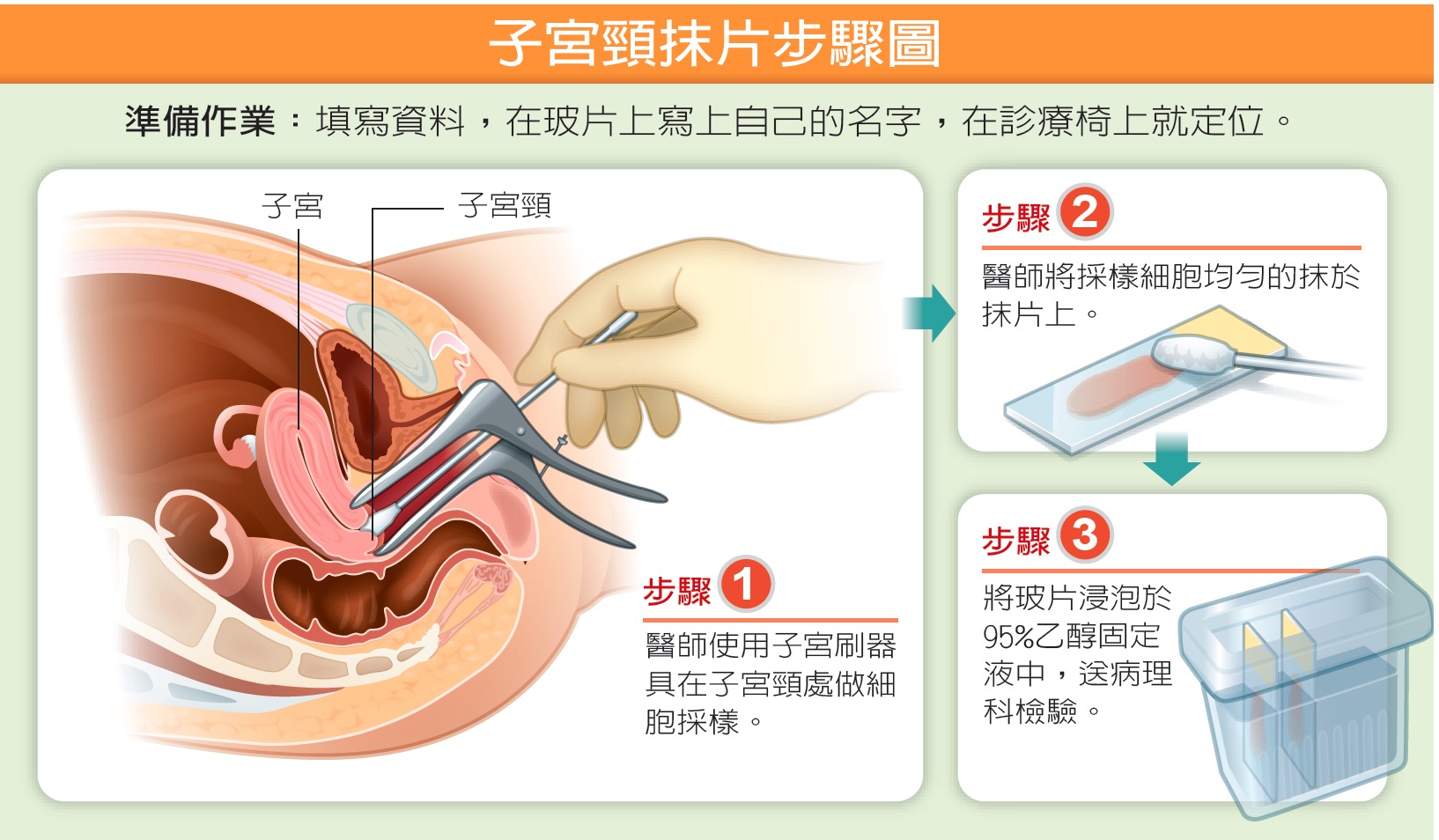 「子宮抹片圖」的圖片搜尋結果