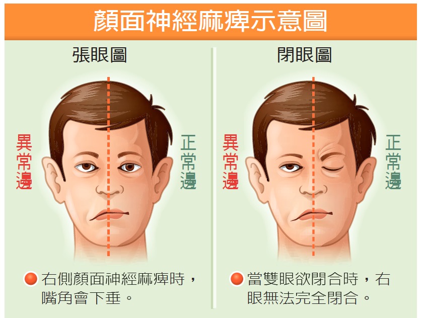 Facialpalsy-s