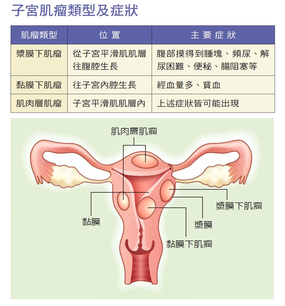 fibromyoma-s