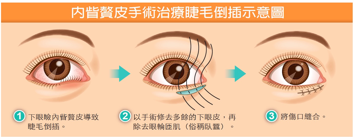 eyelashsurgery-s